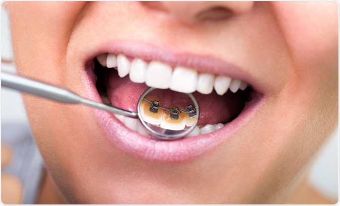 Lingual braces on dental mirror. Image Credit: Lucky Business / Shutterstock